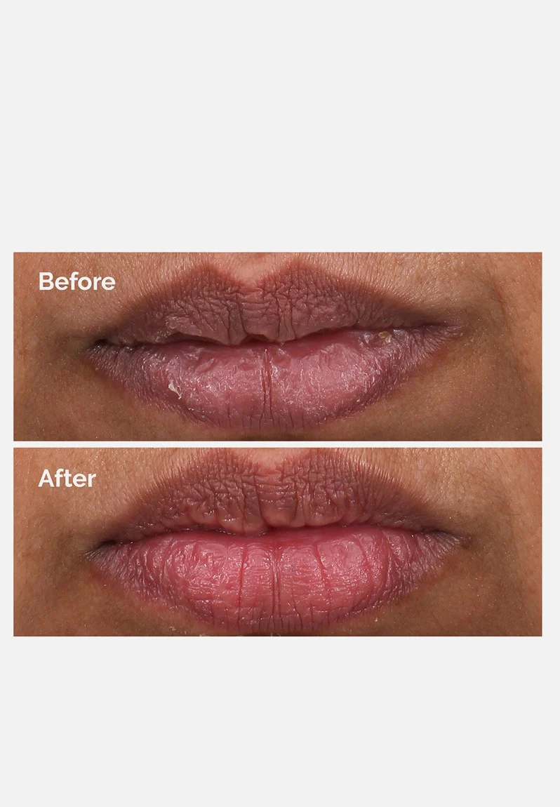 PHA 5% Exfoliating Lip Serum | The Ordinary - Image 3